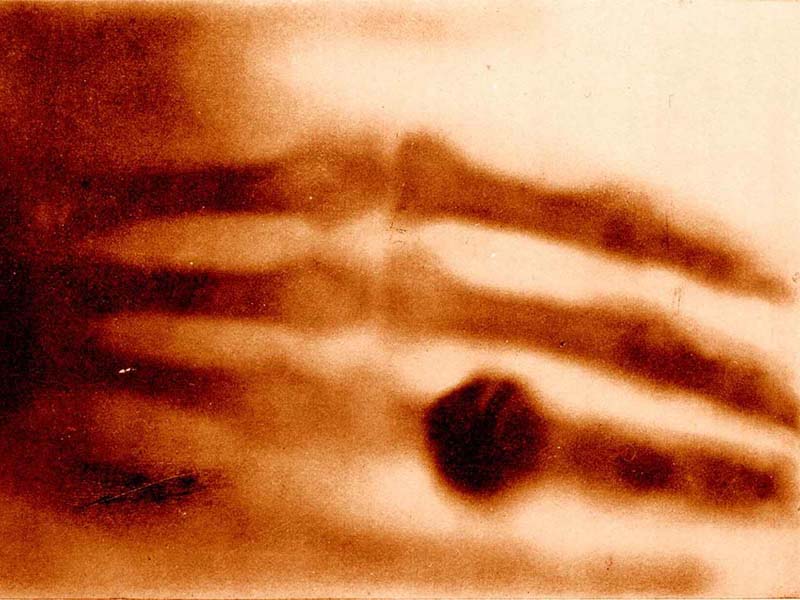 hand X-Ray