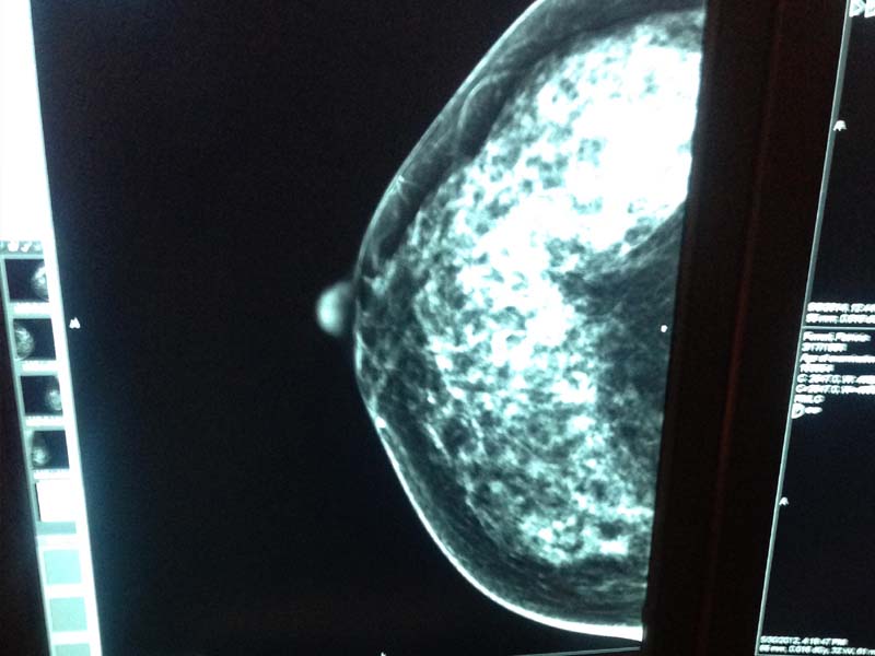 screening mammogram